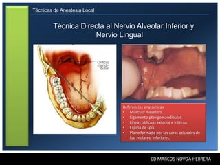 Técnicas de Anestesia Local


         Técnica Directa al Nervio Alveolar Inferior y
                     Nervio Lingual




                               Referencias anatómicas
                               • Músculo masetero.
                               • Ligamento pterigomandibular.
                               • Líneas oblicuas externa e interna.
                               • Espina de spix.
                               • Plano formado por las caras oclusales de
                                   los molares inferiores.



                                              CD MARCOS NOVOA HERRERA
 