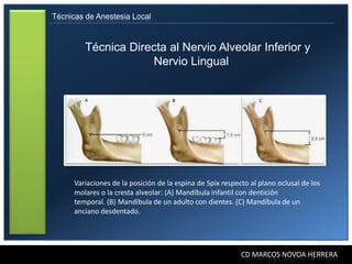 Técnicas de Anestesia Local



         Técnica Directa al Nervio Alveolar Inferior y
                     Nervio Lingual




      Variaciones de la posición de la espina de Spix respecto al plano oclusal de los
      molares o la cresta alveolar: (A) Mandíbula infantil con dentición
      temporal. (B) Mandíbula de un adulto con dientes. (C) Mandíbula de un
      anciano desdentado.




                                                            CD MARCOS NOVOA HERRERA
 