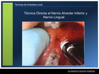Técnicas de Anestesia Local



         Técnica Directa al Nervio Alveolar Inferior y
                     Nervio Lingual




                                        CD MARCOS NOVOA HERRERA
 