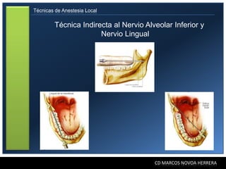 Técnicas de Anestesia Local


         Técnica Indirecta al Nervio Alveolar Inferior y
                       Nervio Lingual




                                        CD MARCOS NOVOA HERRERA
 