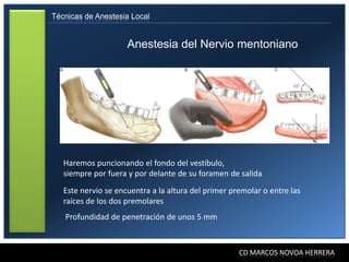 Técnicas de Anestesia Local


                     Anestesia del Nervio mentoniano




   Haremos puncionando el fondo del vestíbulo,
   siempre por fuera y por delante de su foramen de salida
   Este nervio se encuentra a la altura del primer premolar o entre las
   raíces de los dos premolares
   Profundidad de penetración de unos 5 mm



                                                     CD MARCOS NOVOA HERRERA
 