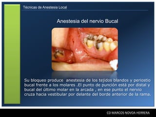 Técnicas de Anestesia Local



                    Anestesia del nervio Bucal




Su bloqueo produce anestesia de los tejidos blandos y periostio
bucal frente a los molares .El punto de punción está por distal y
bucal del último molar en la arcada , en ese punto el nervio
cruza hacia vestibular por delante del borde anterior de la rama.



                                          CD MARCOS NOVOA HERRERA
 