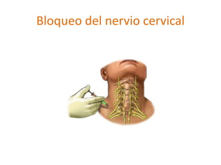 Bloqueo del nervio cervical 
 