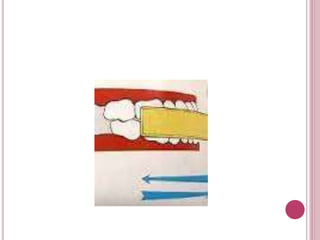 Tecnicas de cepillado