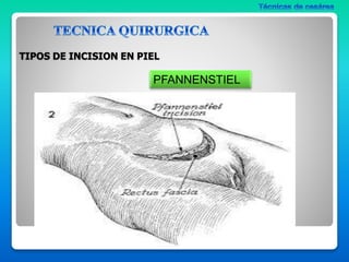 tecnicas quirurgicas de cesarea. seminario..pptx