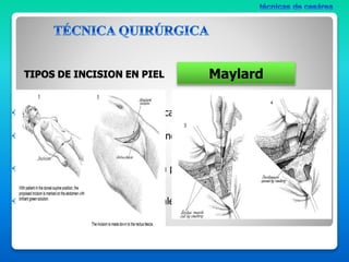 tecnicas quirurgicas de cesarea. seminario..pptx