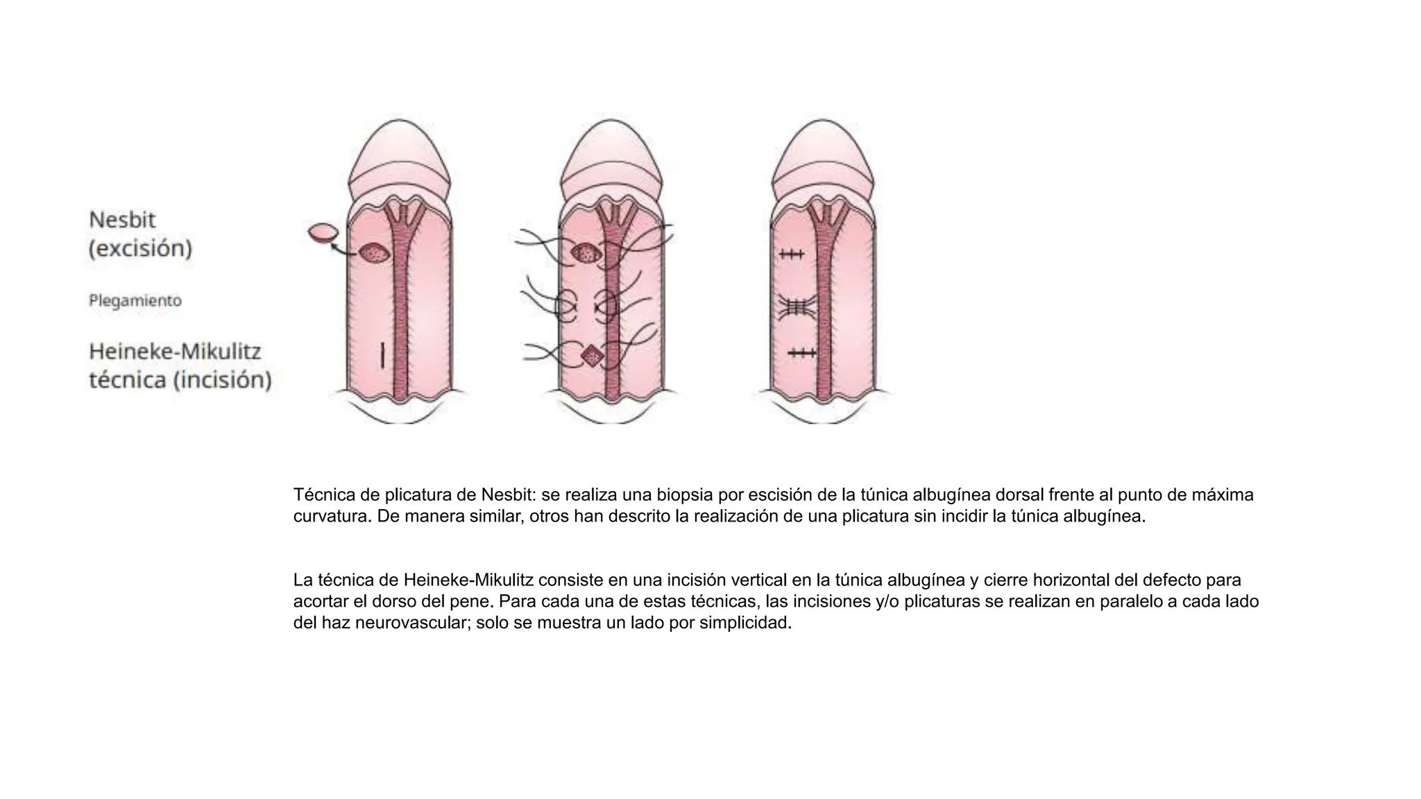 TECNICAS DE PLICATURA PENEANA EN HIPOSPADIAS.pptx