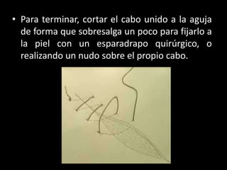 • Para terminar, cortar el cabo unido a la aguja
  de forma que sobresalga un poco para fijarlo a
  la piel con un esparadrapo quirúrgico, o
  realizando un nudo sobre el propio cabo.
 