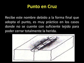 Punto en Cruz

Recibe este nombre debido a la forma final que
adopta el punto, es muy práctico en los casos
donde no se cuente con suficiente tejido para
poder cerrar totalmente la herida.
 