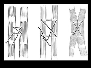 Tecnicas de suturas y puntos