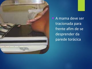 ▪ A mama deve ser
tracionada para
frente afim de se
desprender da
parede torácica
 