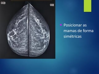 ▪ Posicionar as
mamas de forma
simétricas
 