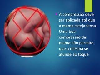 ▪ A compressão deve
ser aplicada até que
a mama esteja tensa.
Uma boa
compressão da
mama não permite
que a mesma se
afunde ao toque
 