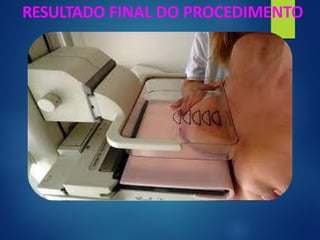 RESULTADO FINAL DO PROCEDIMENTO
 