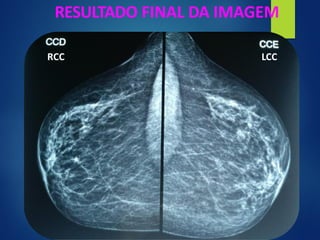 RESULTADO FINAL DA IMAGEM
RCC LCC
 