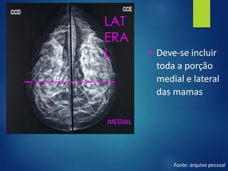 ▪ Deve-se incluir
toda a porção
medial e lateral
das mamas
MEDIAL
Fonte: arquivo pessoal
LAT
ERA
L
 