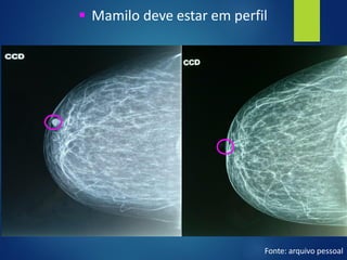 ▪ Mamilo deve estar em perfil
Fonte: arquivo pessoal
 