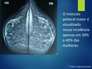 ▪ O músculo
peitoral maior é
visualizado
nessa incidência
apenas em 30%
a 40% das
mulheres
Fonte: arquivo pessoal
 