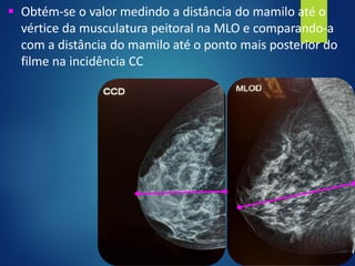 ▪ Obtém-se o valor medindo a distância do mamilo até o
vértice da musculatura peitoral na MLO e comparando-a
com a distância do mamilo até o ponto mais posterior do
filme na incidência CC
 