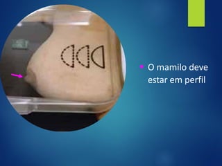 ▪ O mamilo deve
estar em perfil
 