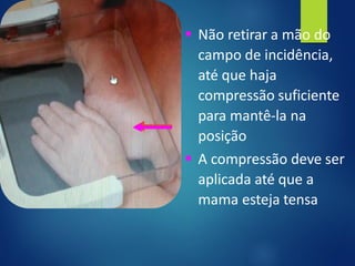 ▪ Não retirar a mão do
campo de incidência,
até que haja
compressão suficiente
para mantê-la na
posição
▪ A compressão deve ser
aplicada até que a
mama esteja tensa
 