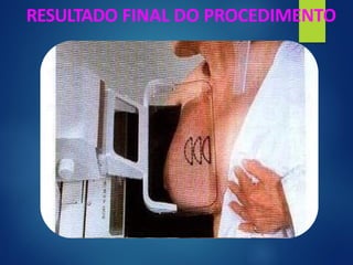 RESULTADO FINAL DO PROCEDIMENTO
 