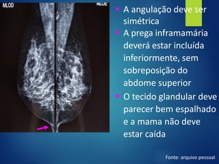 ▪ A angulação deve ser
simétrica
▪ A prega inframamária
deverá estar incluída
inferiormente, sem
sobreposição do
abdome superior
▪ O tecido glandular deve
parecer bem espalhado
e a mama não deve
estar caída
Fonte: arquivo pessoal
 