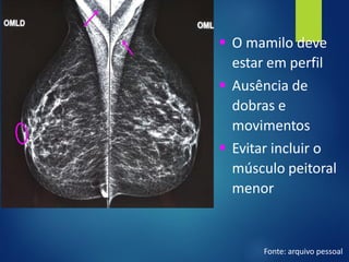 ▪ O mamilo deve
estar em perfil
▪ Ausência de
dobras e
movimentos
▪ Evitar incluir o
músculo peitoral
menor
Fonte: arquivo pessoal
 