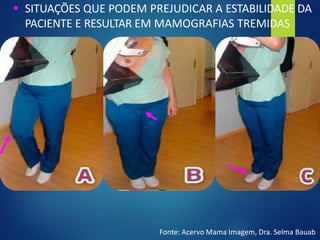 ▪ SITUAÇÕES QUE PODEM PREJUDICAR A ESTABILIDADE DA
PACIENTE E RESULTAR EM MAMOGRAFIAS TREMIDAS
Fonte: Acervo Mama Imagem, Dra. Selma Bauab
 