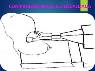 COMPRESSÃO FOCAL OU LOCALIZADA
 