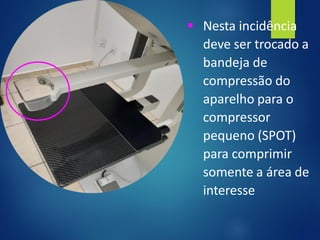 ▪ Nesta incidência
deve ser trocado a
bandeja de
compressão do
aparelho para o
compressor
pequeno (SPOT)
para comprimir
somente a área de
interesse
 