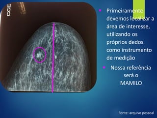 ▪ Primeiramente
devemos localizar a
área de interesse,
utilizando os
próprios dedos
como instrumento
de medição
▪ Nossa referência
será o
MAMILO
Fonte: arquivo pessoal
 