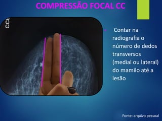 COMPRESSÃO FOCAL CC
▪ Contar na
radiografia o
número de dedos
transversos
(medial ou lateral)
do mamilo até a
lesão
Fonte: arquivo pessoal
 