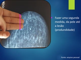 ▪ Fazer uma segunda
medida, da pele até
a lesão
(produndidade)
Fonte: arquivo pessoal
 