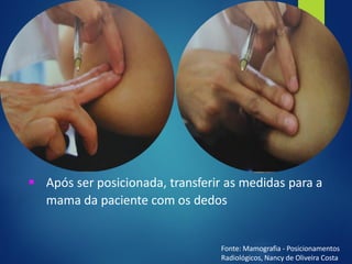▪ Após ser posicionada, transferir as medidas para a
mama da paciente com os dedos
Fonte: Mamografia - Posicionamentos
Radiológicos, Nancy de Oliveira Costa
 