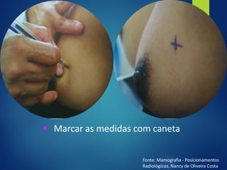 ▪ Marcar as medidas com caneta
Fonte: Mamografia - Posicionamentos
Radiológicos, Nancy de Oliveira Costa
 
