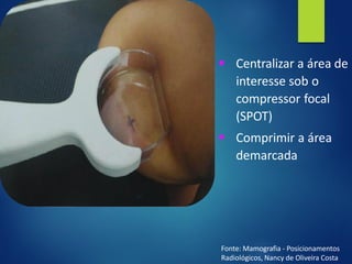 ▪ Centralizar a área de
interesse sob o
compressor focal
(SPOT)
▪ Comprimir a área
demarcada
Fonte: Mamografia - Posicionamentos
Radiológicos, Nancy de Oliveira Costa
 