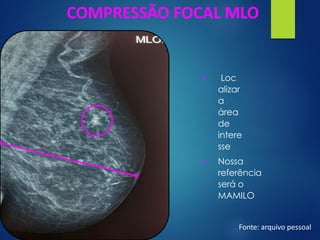 COMPRESSÃO FOCAL MLO
▪ Loc
alizar
a
área
de
intere
sse
▪ Nossa
referência
será o
MAMILO
Fonte: arquivo pessoal
 