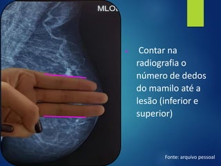 ▪ Contar na
radiografia o
número de dedos
do mamilo até a
lesão (inferior e
superior)
Fonte: arquivo pessoal
 