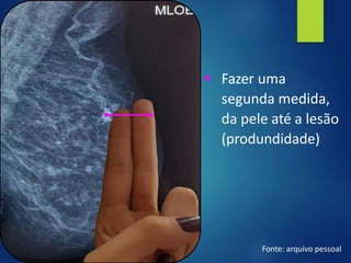 ▪ Fazer uma
segunda medida,
da pele até a lesão
(produndidade)
Fonte: arquivo pessoal
 