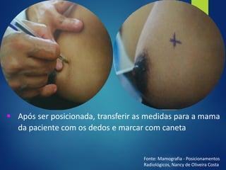 ▪ Após ser posicionada, transferir as medidas para a mama
da paciente com os dedos e marcar com caneta
Fonte: Mamografia - Posicionamentos
Radiológicos, Nancy de Oliveira Costa
 