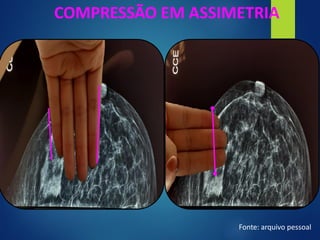 COMPRESSÃO EM ASSIMETRIA
Fonte: arquivo pessoal
 