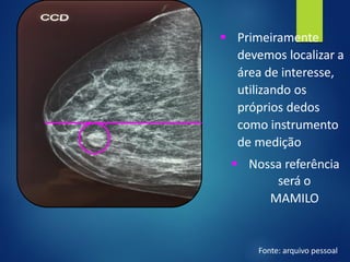 ▪ Primeiramente
devemos localizar a
área de interesse,
utilizando os
próprios dedos
como instrumento
de medição
▪ Nossa referência
será o
MAMILO
Fonte: arquivo pessoal
 
