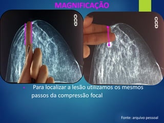 MAGNIFICAÇÃO
▪ Para localizar a lesão utilizamos os mesmos
passos da compressão focal
Fonte: arquivo pessoal
 
