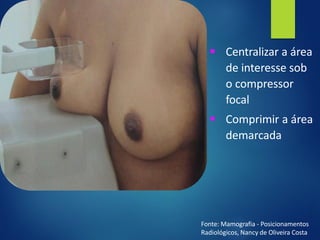 ▪ Centralizar a área
de interesse sob
o compressor
focal
▪ Comprimir a área
demarcada
Fonte: Mamografia - Posicionamentos
Radiológicos, Nancy de Oliveira Costa
 