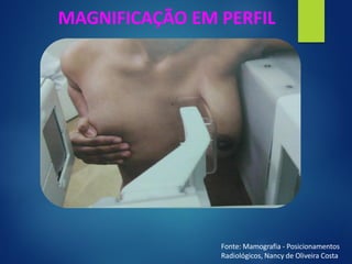 MAGNIFICAÇÃO EM PERFIL
Fonte: Mamografia - Posicionamentos
Radiológicos, Nancy de Oliveira Costa
 