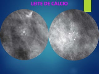 LEITE DE CÁLCIO
 