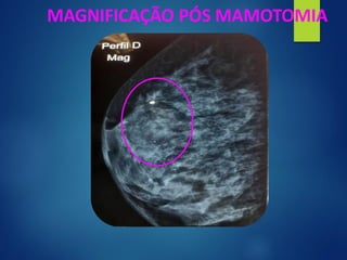 MAGNIFICAÇÃO PÓS MAMOTOMIA
 
