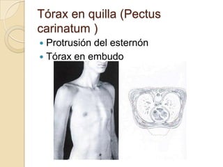 Torax Ex Tecnicas exploratorias de torax lesly | PPTX