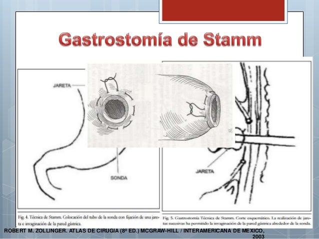 Gastrostomia Cid